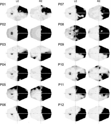 Pulvinar Lesions Disrupt Fear-Related Implicit Visual Processing in Hemianopic Patients